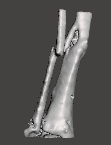 3d_maranon's tweet photo. 3D Model of a fracture of tibia and fibula. This case will increase the repository of medical cases in the Hospital Gregorio Marañón #HospitalMarañon3D The FabLab team carried out this proyect @rupermac @calvoharo_ja @diegotrap @kn_ord @sandrasv97 https://t.co/rkQZbWr0ln