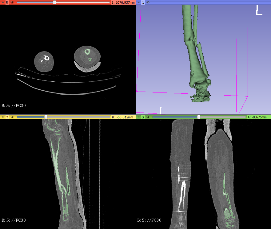 3d_maranon's tweet photo. 3D Model of a fracture of tibia and fibula. This case will increase the repository of medical cases in the Hospital Gregorio Marañón #HospitalMarañon3D The FabLab team carried out this proyect @rupermac @calvoharo_ja @diegotrap @kn_ord @sandrasv97 https://t.co/rkQZbWr0ln