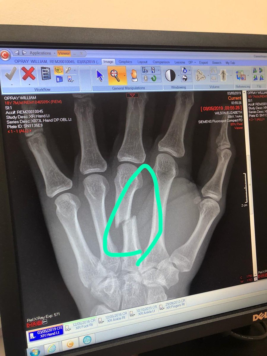 Good luck to <a href="/willopray/">willopray</a> with op on his hand tomorrow after getting stamped on in Cup final 👍💙