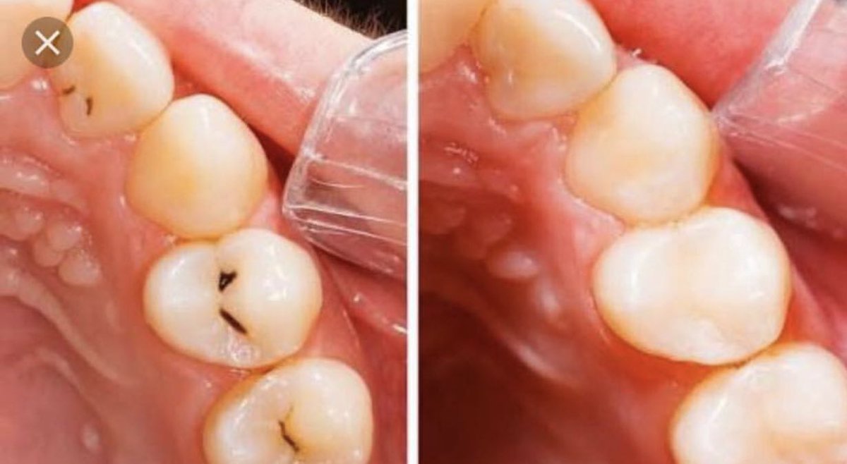bjluis's tweet photo. #PROMOCIÓN resinas dentales #3x2 aprovechen. https://t.co/w7a9CH2GFK