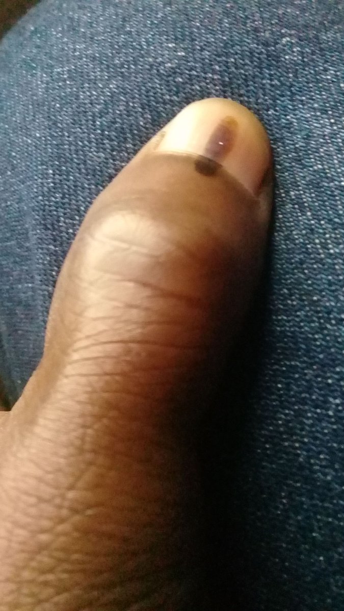 1804redx's tweet photo. @Julius_S_Malema My vote was enough to alleviate the pain I've been carrying, being landless it's a hurtful thing &amp; living in poverty it's a shame. #IamVotingEFF Done!!! https://t.co/WNdaPmaChi