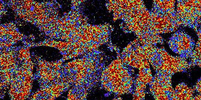MCR_AACR's tweet image. Elevated PAI1 (SERPINE1) drives glycolytic metabolism, actin rearrangement, and increased invasiveness in TNBC models. bit.ly/2Jc4J0C