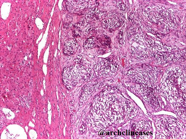 archclincases's tweet photo. Let's go back to this interesting case published a while back: Calcifying nested stromal-epithelial tumor (CNSET) of the liver.
Read all about it in Archive of Clinical Cases:
https://t.co/OJ7r6qKaNq …
#GIpath #pathology #LiverPath https://t.co/rVYxVlYmlm