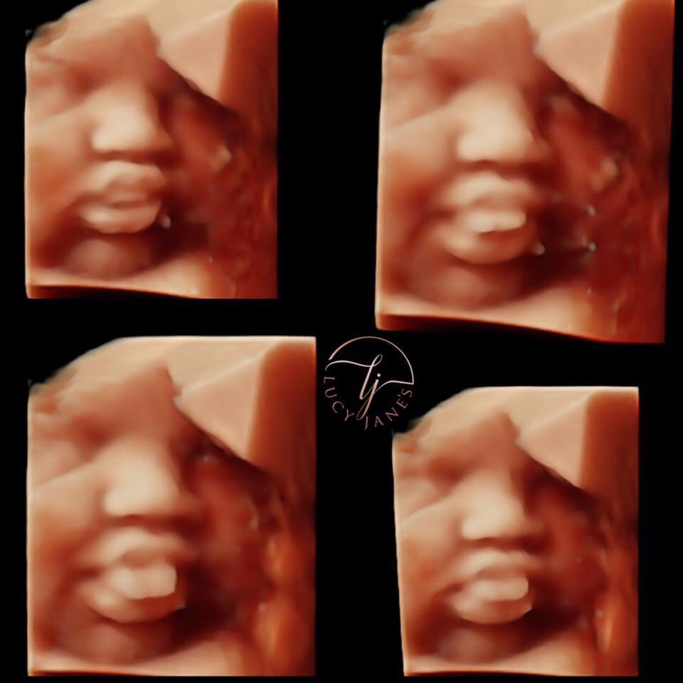 ljpregnancyco's tweet photo. That tongue 🥰🥰 #LucyJanes #ultrasound #ultrasoundclinic #babyscan #babyscanclinic #pregnancy #pregnantbelly #pregnant #mumtobe #yummymummy #midwife #humpday #GRLPOWR #Happiness #MumsToBe https://t.co/FeNlZYKivE