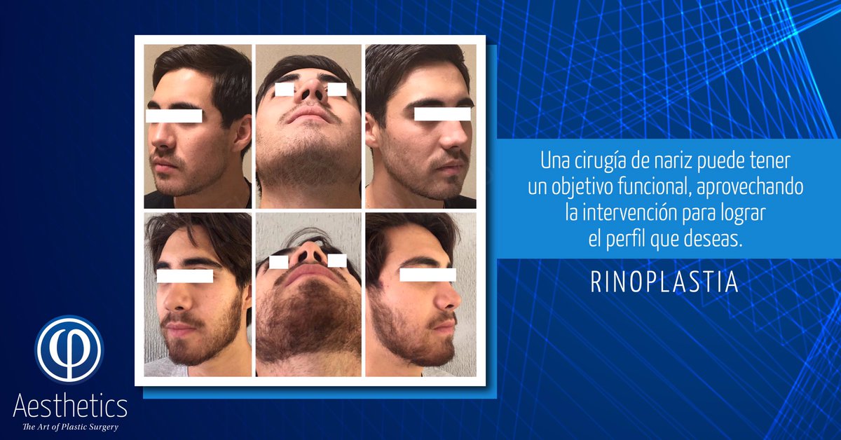 gjcplastico's tweet photo. Puedes optar por una rinoplastia con fines funcionales, y aprovechar para corregir algún detalle que te haga lucir el perfil que siempre has deseado. ¡Permítenos valorarte! 👨‍⚕️

Haz tu cita de valoración hoy mismo llamando al (477) 7132835, ¡será un gusto atenderte! https://t.co/uHfNbBMW7y
