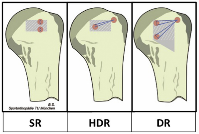 As #subscapularis tears are recognized, they are more commonly repaired. A great study here in the May issue on the biomechanics of subscpaularis repairs. Link: sciencedirect.com/science/articl…