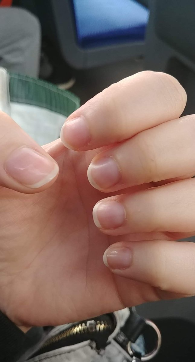 harleydhm's tweet photo. My review of the @nailogical nail oil. First pic was Feb 22,and the other May 9th. Its MAGIC! https://t.co/URq9srIpK5