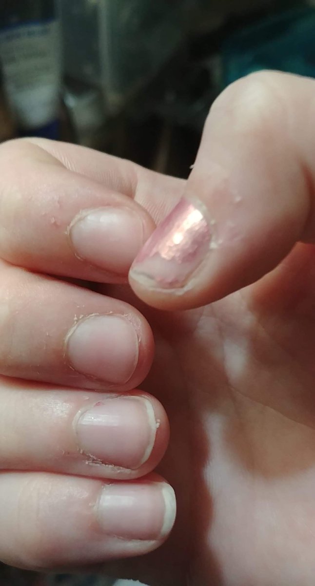 harleydhm's tweet photo. My review of the @nailogical nail oil. First pic was Feb 22,and the other May 9th. Its MAGIC! https://t.co/URq9srIpK5