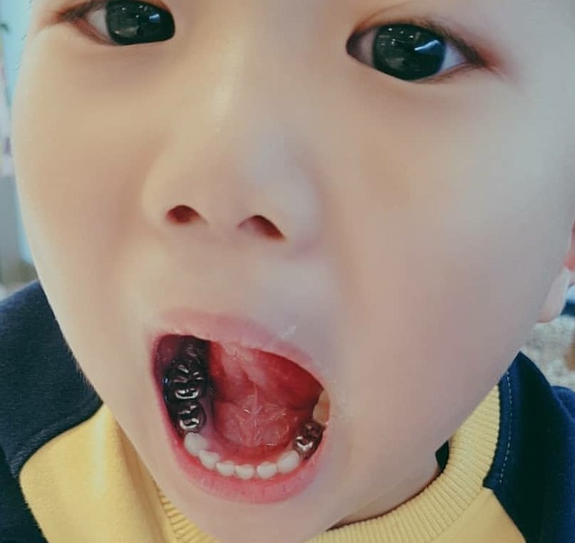 乳歯冠 - Search / X