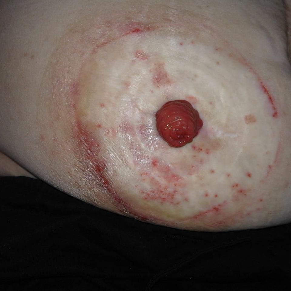 Henriette (58) was de wanhoop nabij. Door de vele lekkages was haar huid heel slecht. Wijkverpleegster Linne Jacobs ging op zoek naar een oplossing. Op internet vond Linne informatie over de Stomydo stomadouche stomydo.com/nl/updates/dym…  #stoma #stomydo #innovatie #ostomy