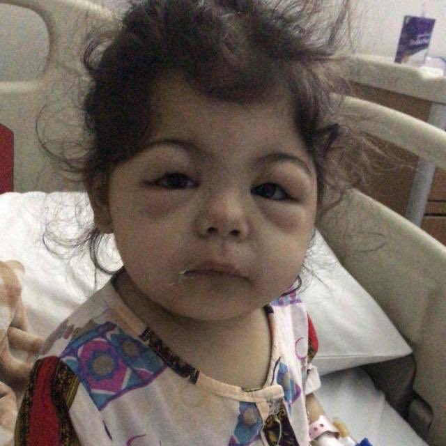 malaak989's tweet photo. #اليتيمه_فوزا_تطلب_فزعتكم  بنت يتيمه عمرها سنه ونصف من القبائل النازحة اصيبت بمرض نقص البومين او زلال في الكلى و حالتها الصحية تعبانه تتعالج في الشميسي مع والدتها و بحاجه لوقفة اهل الخير 
رقم التواصل : 05351:65946 https://t.co/Z1SHYoWr7w