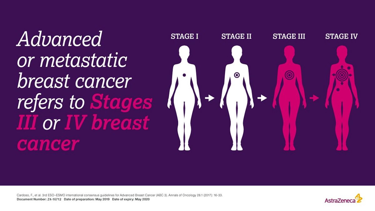 Metastatic Breast Cancer (MBC) is the most advanced stage of breast cancer ...