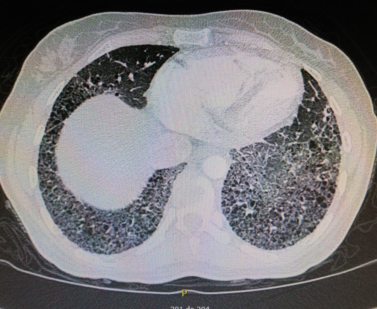 pg_saavedra's tweet photo. A 44 yo female patient with Pulmonary Fibrosis and isolated c - ANCA positivity: 84.8 (rv 0 - 4.9) u/mL. No other symptoms or complaints besides dyspnea. #drpubliosaavedrareumatólogo #therheumatologydoctor #rheumatology #Reumatología #MEDELLÍN #LungFibrosis https://t.co/4S0vE5d3vz