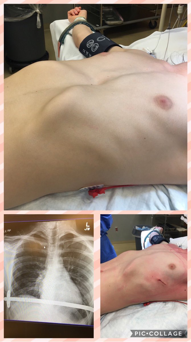 KashIrshad's tweet photo. Excellent result today. #Nuss for #pectus excavatum. One bar, one stabilizer, lots of fiberwire. Patient provided permission to post. @OslerHealth @MCHPedSurg @ctsnetorg @PectusAwareness #sunkenchest @PhxChildrens https://t.co/MCFFn1RD0w