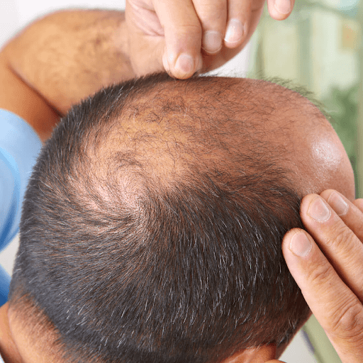 clinicaimapy's tweet photo. Sabías  que 1 de cada 5 mujeres y 3 de cada 5 hombres, presenta síntomas de #Alopecia. En #ClínicaIMA contamos con especialistas que pueden ayudarte a mejorar la condición con tratamientos altamente efectivos  ✍☺
#Salud #Estética #Tips #Tratamientos https://t.co/WBKw2GVHsh