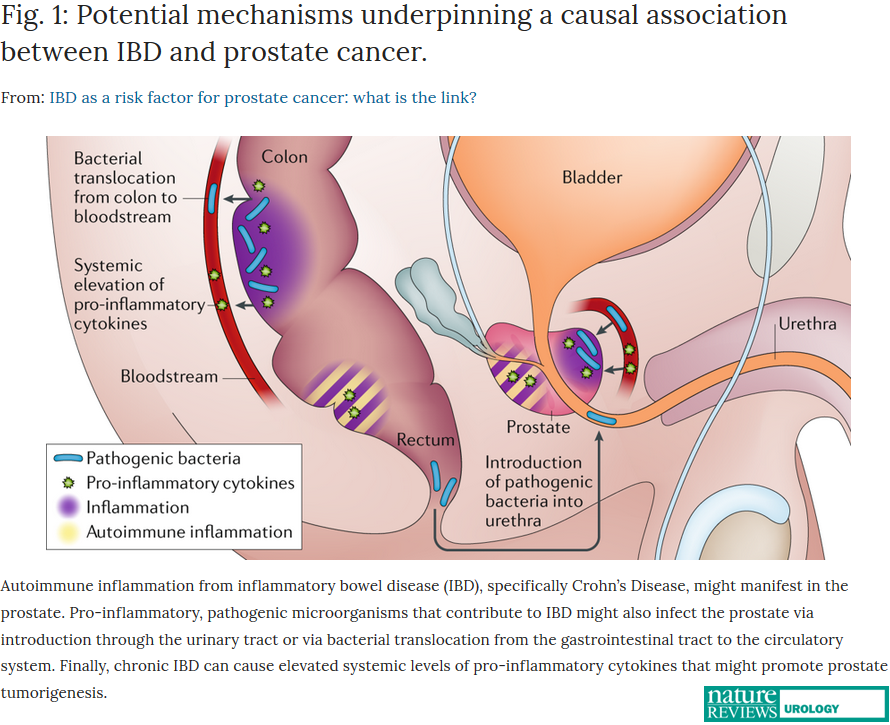 NatRevUrol's tweet photo. MAY ISSUE | News&amp;Views: Chronic prostatic inflammation is a suspected risk factor for #ProstateCancer. @sfanoslab &amp; Joshu comment on new data that link inflammatory bowel disease with increased prostate cancer risk and discuss possible mechanisms https://t.co/s7OVdVju9E #IBD https://t.co/SLMLmaPrW5