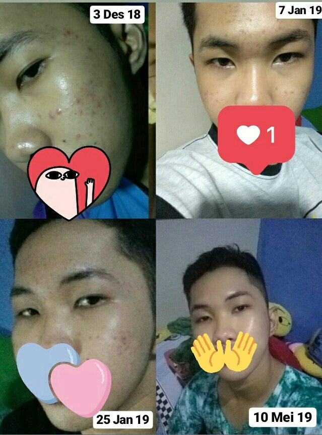 socrateskid's tweet image. -MY JOURNEY TO BE PATIENT AND SURVIVE ON MY ACNE SKIN-

( A man skincare ) 

🚩A THREAD
