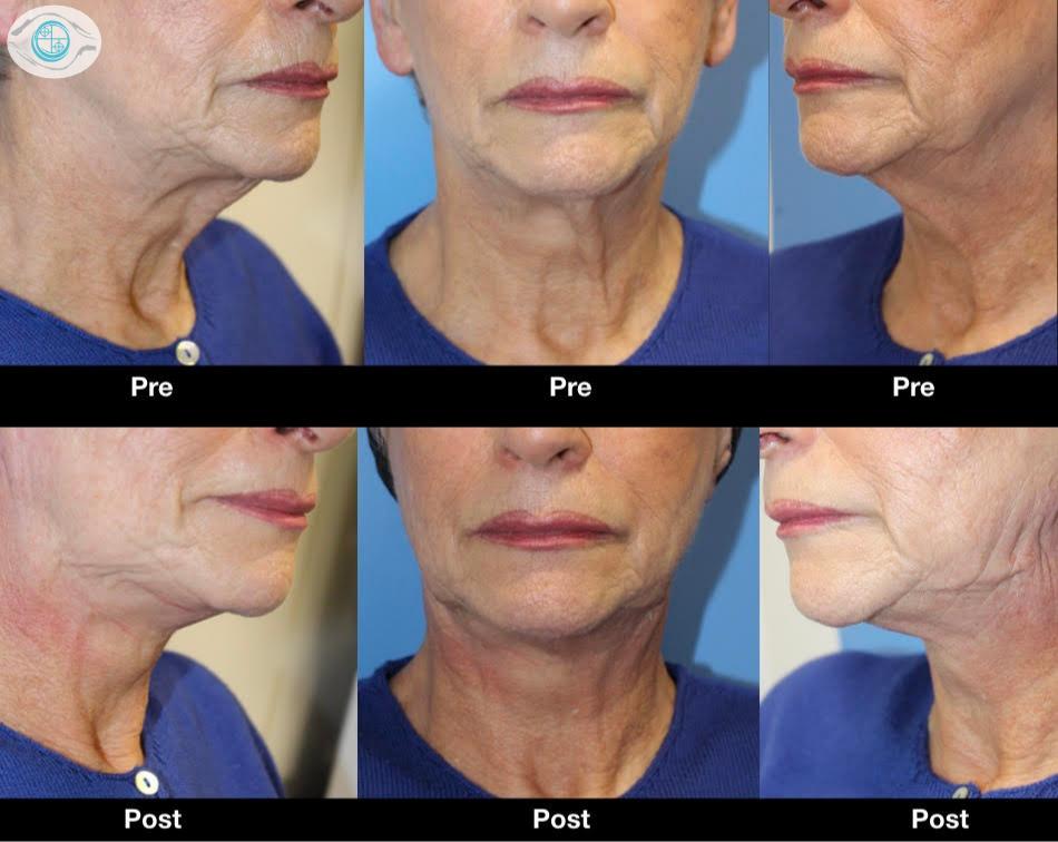 I fili in PDO insieme a filler a base di acido ialuronico ed alla tossina botulinica permettono di mantenersi giovani in maniera naturale negli anni. 

oculoplasticabernardini.it/7413-ringiovan…

#filiriassorbibili #filipdo #filler #facefiller #noninvasive