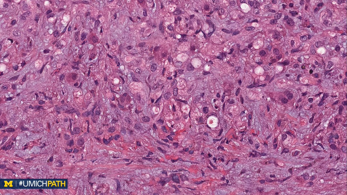 🔬 Gastrointestinal &amp; Liver #Pathology, Day 2

➡️ What’s your #DailyDx of this liver mass?
 
➡️ What’s the most common recurrent genetic alteration found in this entity?
 
➡️ Answers &amp; quick facts tomorrow!
 
#UMichPath #GIPath #LiverPath