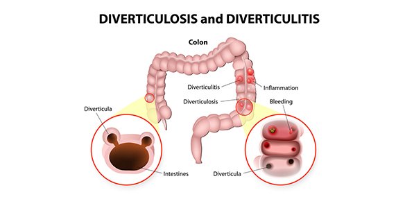 Кандидоз кишечника схема. Дивертикулёз сигмовидной кишечник. Дивертикулёз кишечника толстой кишки. Дивертикулярная болезнь кишечника. Дивертикулярная болезнь.