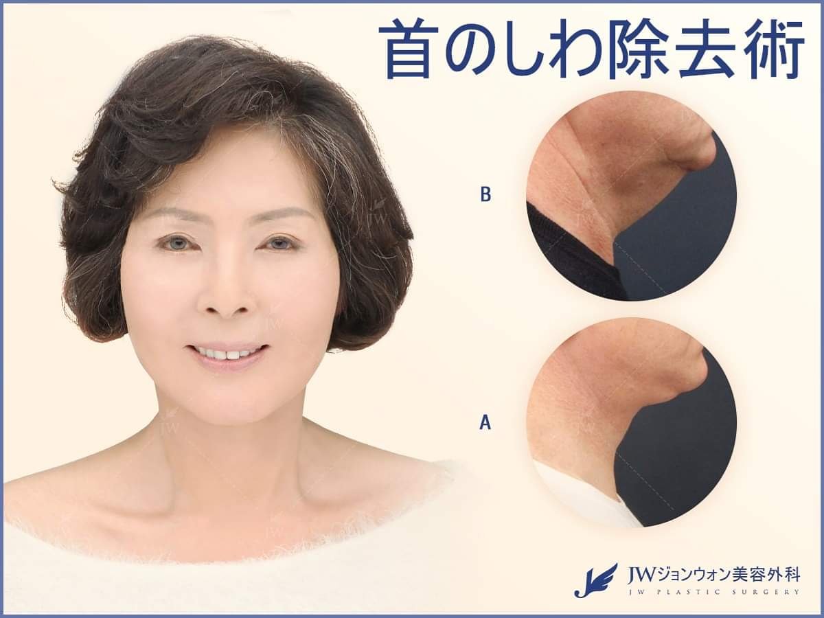 首のしわ 首のしわ