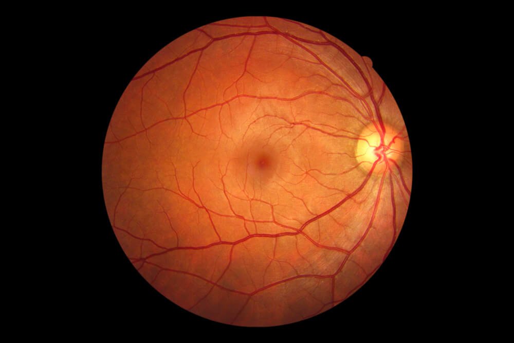 As per a study out of #China, single-field non-mydriatic funds photography is inadequate to detect diabetic retinopathy. bit.ly/2YnCeAr 

#Diabetes #Diabetic #Retinopathy #Retina #FundusCamera #Screening