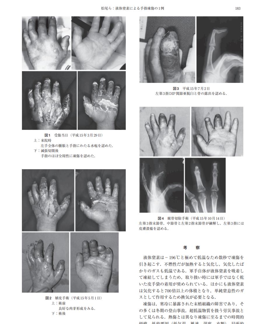 Keizo Takasuka 液体窒素使用時は専用手袋が大事 ただの皮手袋で機械修繕のため数分に渡って我慢して浴びたという何ともな例 怖いのは組織固定されているので凍結直後は皮膚に変化が見えないこと 図1上 でも実際には組織は激しく損壊している 松尾ら