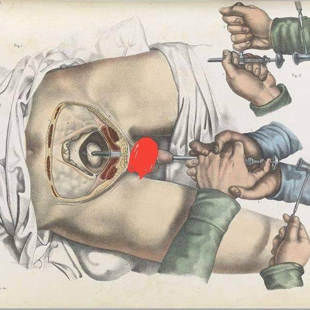 Steampunk_T's tweet photo. In the 19th century, to break a stone from their bladder, men had to pass a nail through their penis and then use a hammer to break it into pieces small enough to pass through their urethra. The was performed without anesthesia until around 1846. Via Reddit https://t.co/xZcEZiK38D