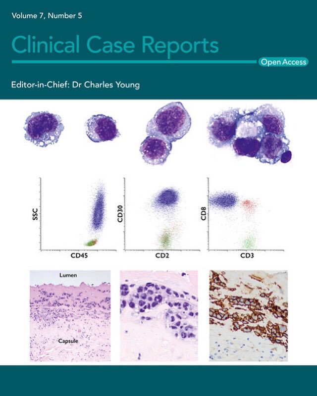 SueEPig's tweet photo. Look what got chosen to be featured on the front cover of the upcoming issue of Clinical Case Reports 💁🏻‍♀️ #coverimage #hhpath #biaalcl #breastimplantcancer #hemepath #cytopath #clinicalcasereports #recentlypublished https://t.co/hPgEEf2du8