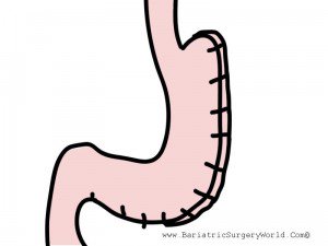BariatricWorld's tweet photo. #Gastric Plication vs Gastric Sleeve – which is the #rightprocedure✔️for you? Know here. https://t.co/lr5iu6Lrik https://t.co/VPMYNRCVea