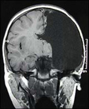 When Christina Santhouse was 8 years old she had the right side of her brain removed due to a rare disorder that can cause as many as 150 seizures every day. She grew up to get a master's degree and become a speech pathologist.