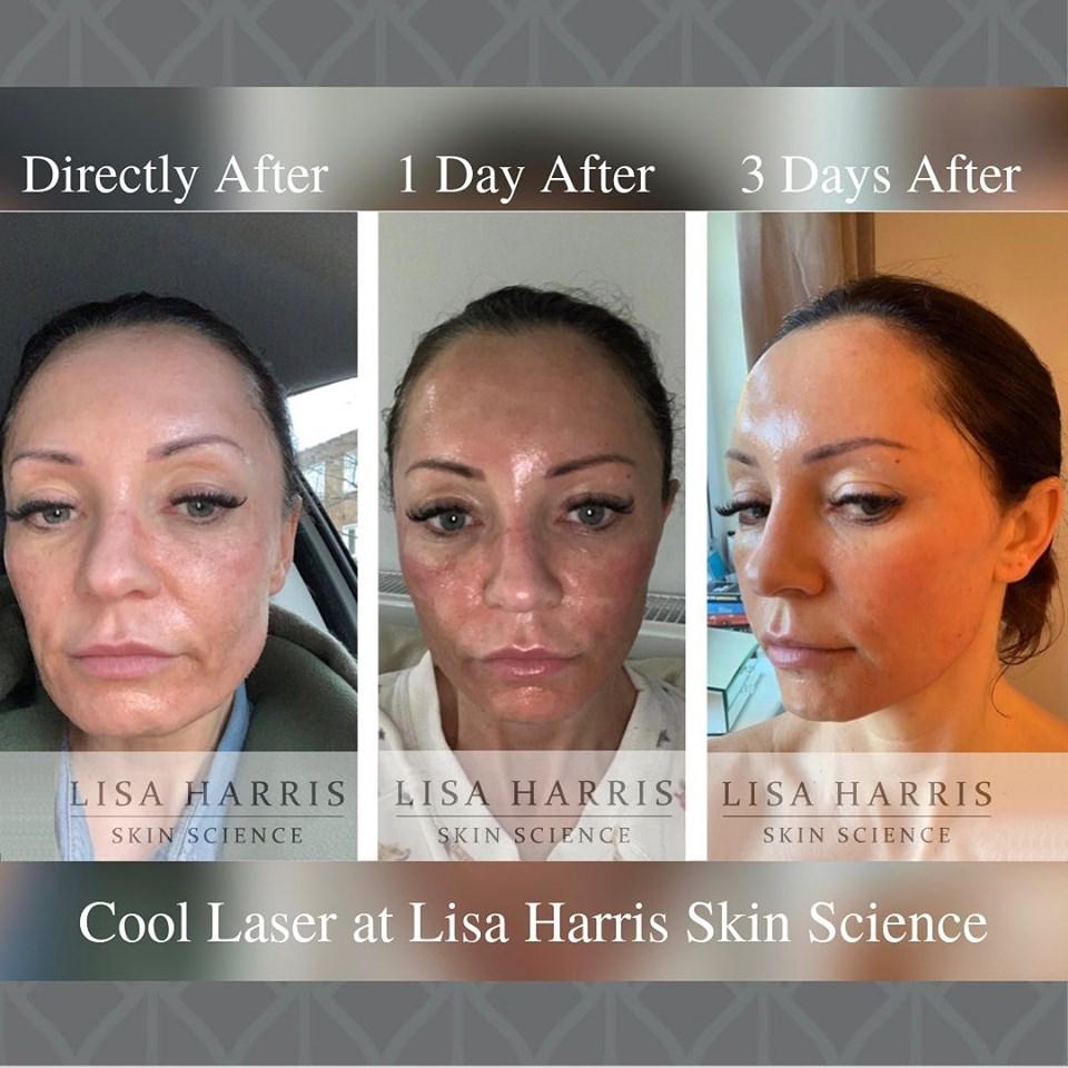 LisaHarrisSkin's tweet photo. The healing process of Cool Laser. Many clients have been asking how their skin will look after cool laser. Here is a fantastic example from one of our lovely clients. 
#coollaser #beforeandafter #healing #laser #skin #treatment https://t.co/O6NogJT5uG