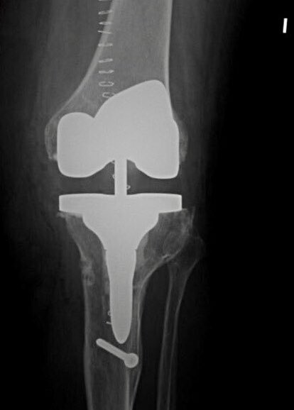 DrAdrianBarrera's tweet photo. En la cirugía de #revisión de una #prótesis #unicompartimental #rodilla: Un 20 a 40% necesitarán algún tipo de vástago y cuña tibial https://t.co/W8c9d54rdt… @ICJRortho @ClinicaCEMTRO https://t.co/sLR4gx9sw3