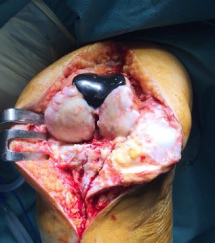 DrAdrianBarrera's tweet photo. En la cirugía de #revisión de una #prótesis #unicompartimental #rodilla: Un 20 a 40% necesitarán algún tipo de vástago y cuña tibial https://t.co/W8c9d54rdt… @ICJRortho @ClinicaCEMTRO https://t.co/sLR4gx9sw3
