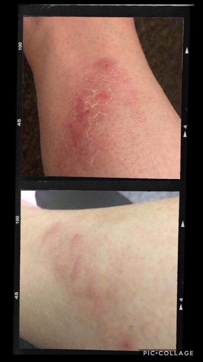BengoughAmy's tweet photo. Ohhhh my days!!😱....Just look at the difference on this lady😧😨...it’s just amazing!!❤️....Honestly, the power of our products💜....#AloeVera #Natural #Healing💜💜 https://t.co/xlFmsyFbW3