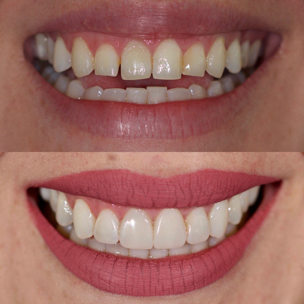 restorativeDS's tweet photo. Mark your calendar: Saturday September 28, 2019 @8:00 am in Atlanta, GA “Mastering the functional prototype for partial and full mouth rehabilitation. Hands-On” 8CE credits. (30 participants) More info? PM or email romerodentalseminars@gmail.com https://t.co/lQAtTNxMde