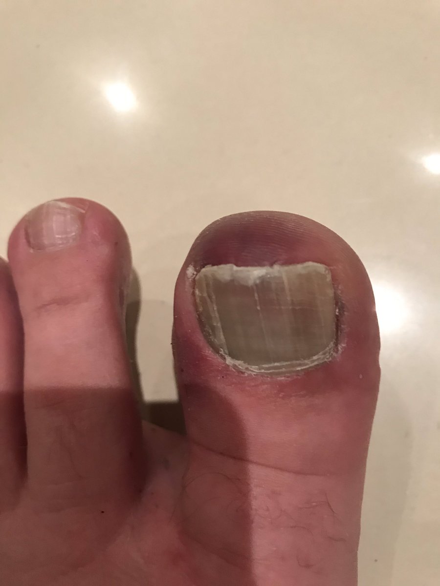 batonflipper's tweet photo. This is what happens when the bowler bowls a Yorker and the ball, bat and boot all come together! I managed to keep it out when this happened earlier but eventually he aimed at the same toe again and bowled me....#veryverypainful #isitbroken #goodjobidonotstandupforajob https://t.co/BW11DhTczj