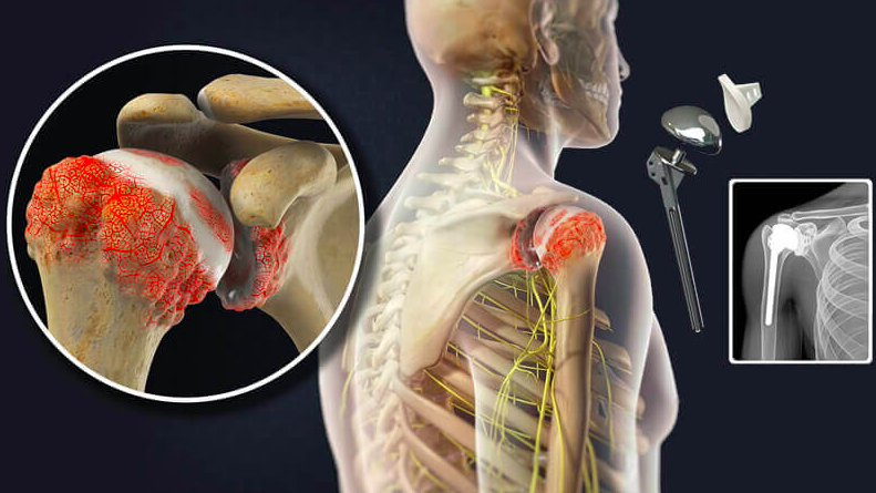 orthodocjones's tweet photo. Total #ShoulderArthroplasty is a great procedure for patients with #arthritis. But it can be technically challenging secondary to #BoneLoss, deformity, and difficult exposure.
Here's how we are tackling these challenges.
https://t.co/1tBFMO1iXH
#CoSportsDoc #ColoradoSprings https://t.co/LtWngCi02y