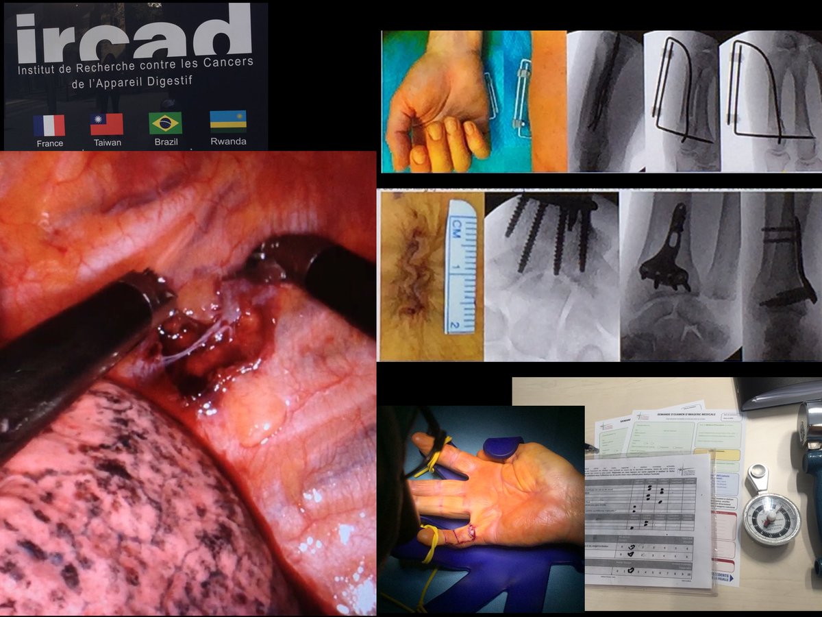 Thanks Prof Liverneaux and SECMA for this great experience, learning tricks about MIS hand surgery, robotic nerve transfers, research..to take home! merci beaucoup à toute l'équipe. SECMA Traveling Fellowship Program. SOS Main, Strasbourg, France. <a href="/drpedrojdelgado/">Dr Pedro J Delgado</a> <a href="/DrFPolo/">Dr.Polo</a>