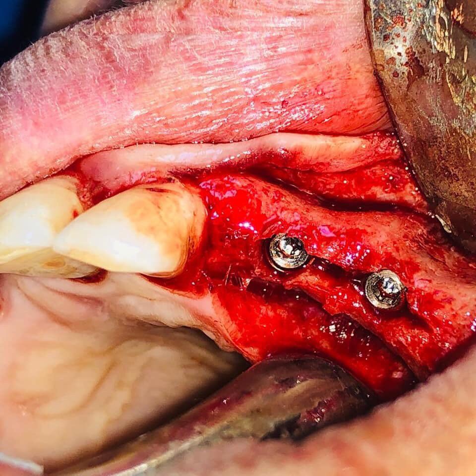 Profess86947462's tweet photo. Clinical day ✨

4 Implants

Dr. Nagy soliman and Dr. Roudaina said 

Under supervision:-
Dr. Mohamed Salah

#TUT
#tut_implants
#clinical
#courses https://t.co/RTFUki20Jf