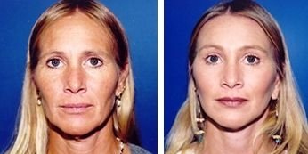 CheatAging's tweet photo. Organic Facelifts: Facial Aerobics Craft The Flawless No Surgery Facelift https://t.co/VVT6k77p1p https://t.co/HpXE9VTgQO