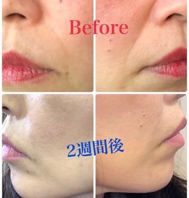 韓国江南 陳整形外科 Ar Twitter ほうれい線が無いと10歳以上若く見えます 自己真皮再生術はダウンタイム48時間 韓国美活 韓国整形 韓国旅行 陳整形外科 ほうれい線 シワ