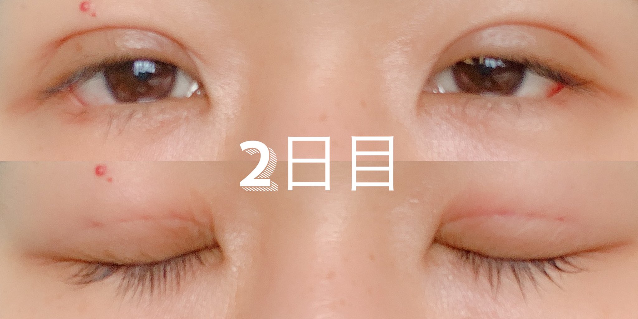 タレ目整形 Twitter Search Twitter