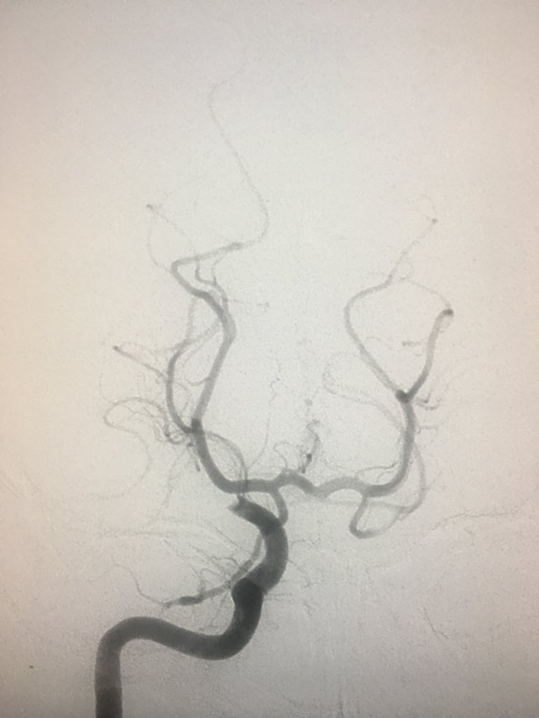WayneOlan's tweet photo. 65 y/o female, NIHSS 21, onset 4.5 hrs ago. 3x mismatch on #Rapid. Aspiration first then Stentriever, #Riptide and #Embotrap. 17 min, sheath to TICI3! #HappyMothersDay #ItsBetterOn23rdStreet https://t.co/mJzDL1vCx8