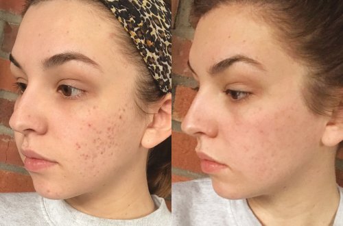 AdyYou2's tweet photo. @AcneElimination CO2 laser acne and scars removal machine from Sincoheren. With good quality and competitive and affordable price. If any questions, pls do not hesitate to contact me. Thanks so much. #beauty #aesthetic #manufacturer #fda https://t.co/vh73QlAhtT