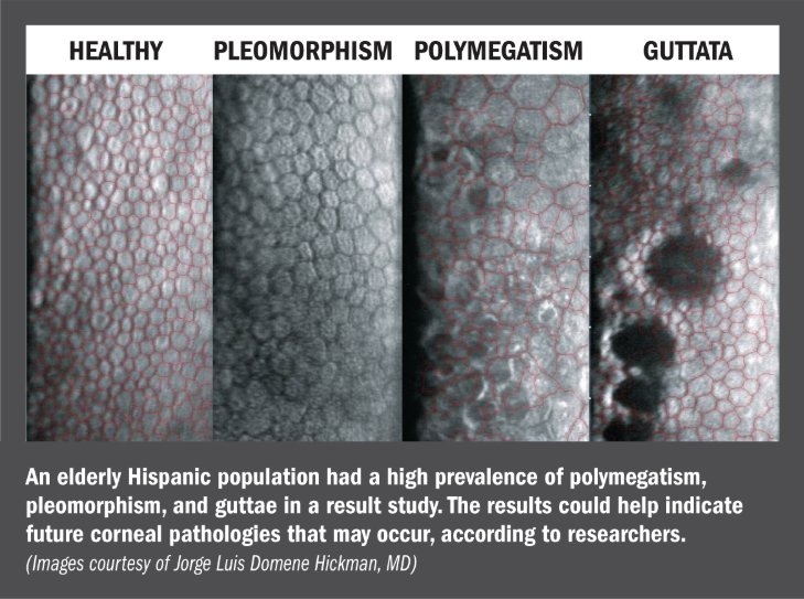 Corneal endothelium characteristics vary depending on patient ethnicity buff.ly/2UKP8X7