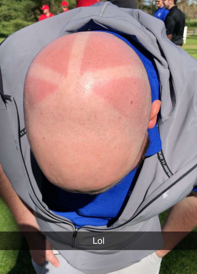 petemckenziezlx's tweet photo. My golf buddy has something to show off at work this morning. Typical Massachusetts Man getting a sunburn on the golf course 😂⛳️ https://t.co/deSdxK9VjI