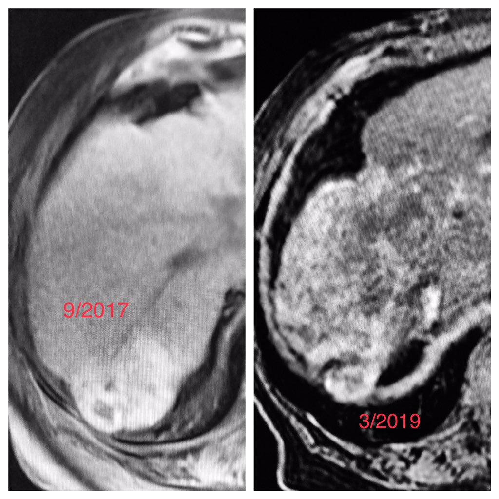 MTV_IR's tweet photo. 54 y/o F w/history of multifocal #HCC on #transplant list developed recurrence 18 mo after good response from #Y90. Suspected phrenic supply. DEB #TACE treatment to RPA.
#MTVIR #HepatocellularCarcinoma #InterventionalRadiology #ExpertsInEmbolization #IRad #MIIPs @drprestongs https://t.co/VB2vlbOI5m