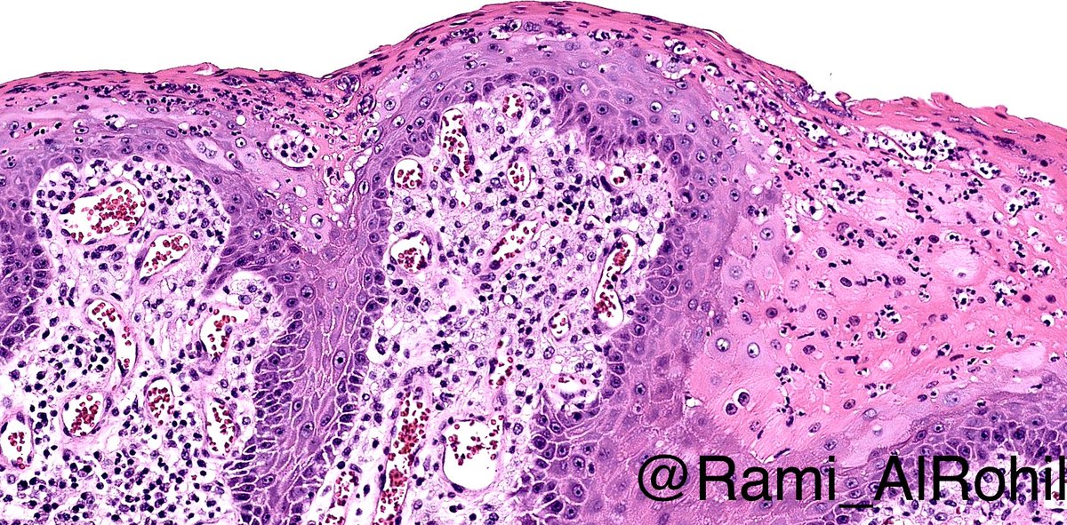 Verruciform xanthoma: usually single lesion, most commonly in oral cavity/external genetalia, Non-HPV. Verrucous-like growth, prominent neutrophilic infiltrate in the overlying para/orthokeratosis, dermal papillae with xanthomatous histiocytes #Pathology #Dermpath #Dermatology