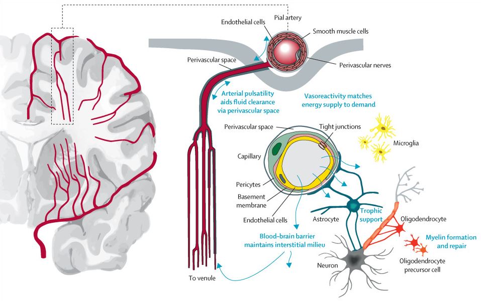 ONLINE FIRST: Mechanisms and clinical implications of small vessel disease thelancet.com/journals/laneu…